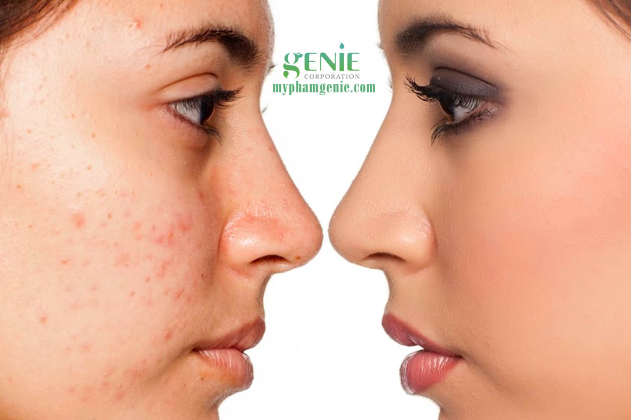 Review serum trị mụn hàn quốc genie