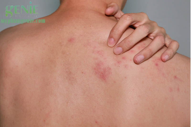 Cách trị mụn lưng nhanh nhất bạn nên biết
